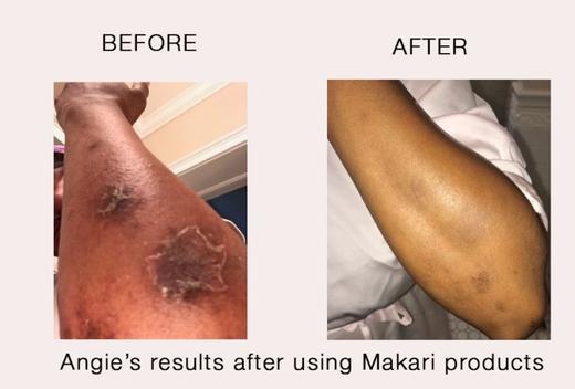 Sind Makari-Produkte nur für die Aufhellung der Haut zu gebrauchen?